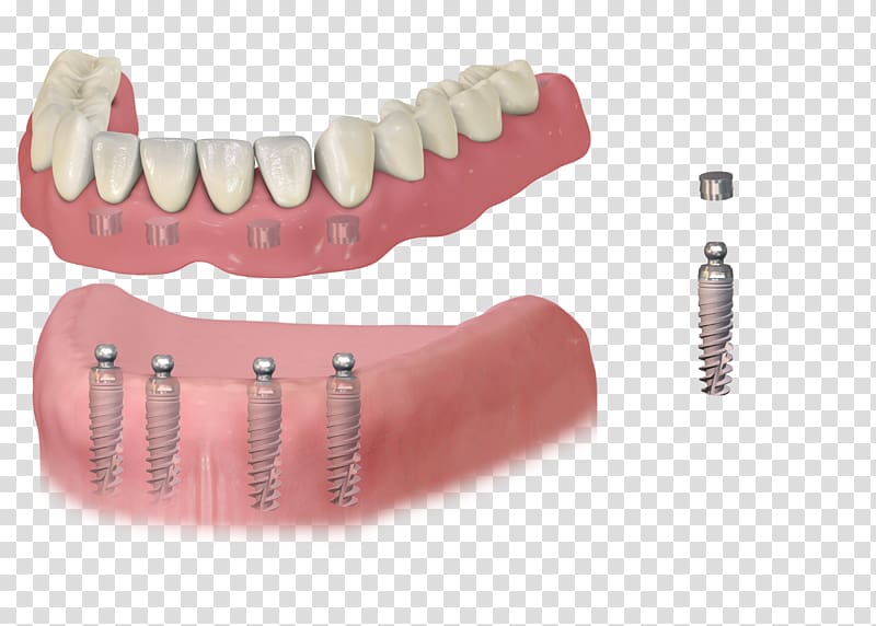 Dental implant Dentistry Dentures Removable partial denture, bridge transparent background PNG clipart