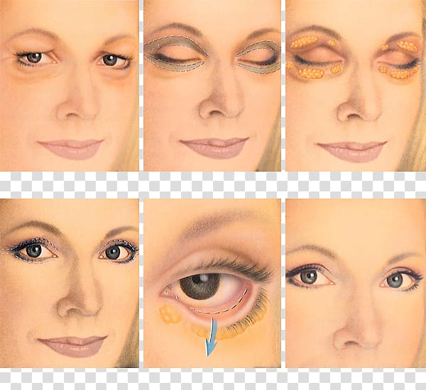 Blepharoplasty Eyelid Surgery Periorbital puffiness, biomedical cosmetic surgery transparent background PNG clipart