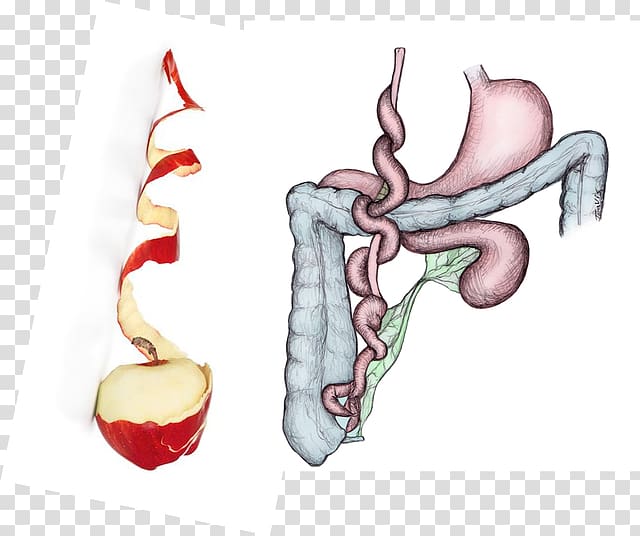 Intestinal atresia Large intestine Jejunum Stenosis, intestine transparent background PNG clipart