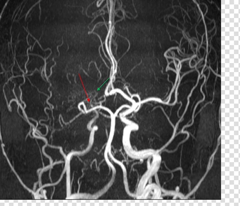 Medical imaging Magnetic resonance angiography Moyamoya disease Magnetic resonance imaging, Posterior Cerebral Artery transparent background PNG clipart