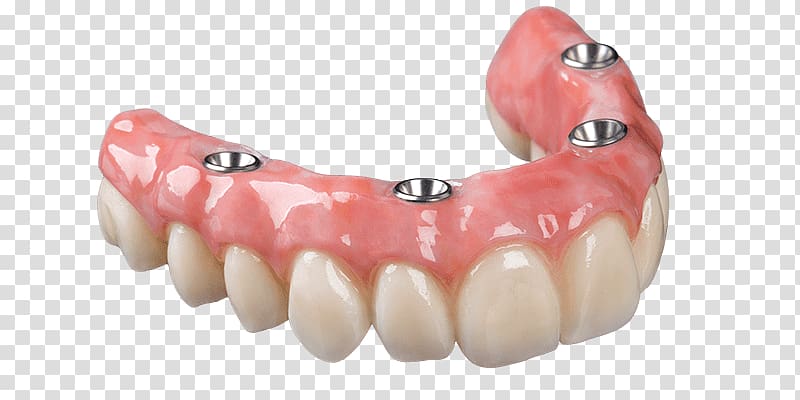 Dental implant Dentures Removable partial denture Dental prosthesis Dentistry, bridge transparent background PNG clipart