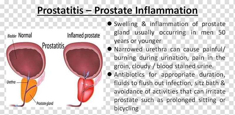 Acute prostatitis Prostate Benign prostatic hyperplasia Urinary tract infection, prostate gland transparent background PNG clipart