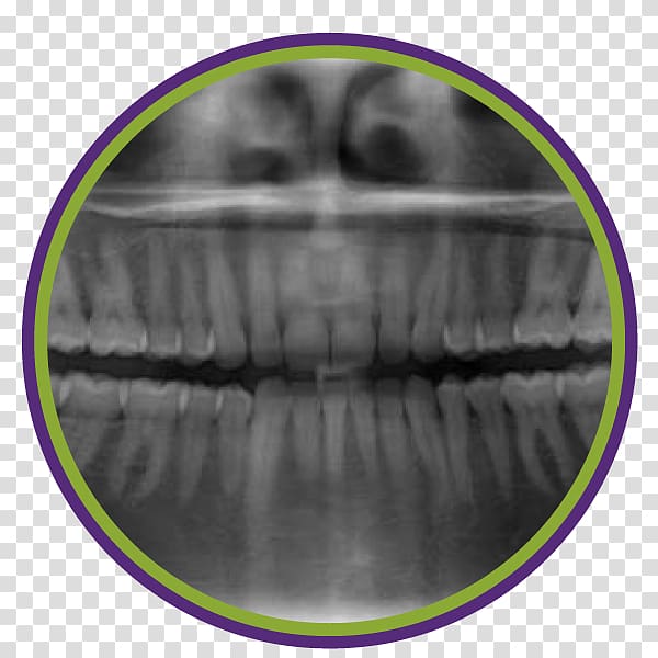 Dentistry Periodontal disease Tooth Periodontosis Dental radiography, tooth cavity transparent background PNG clipart