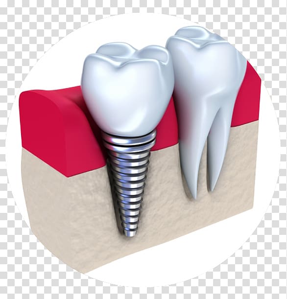 Dental implant Dentistry Dentures, implant dentistry transparent background PNG clipart
