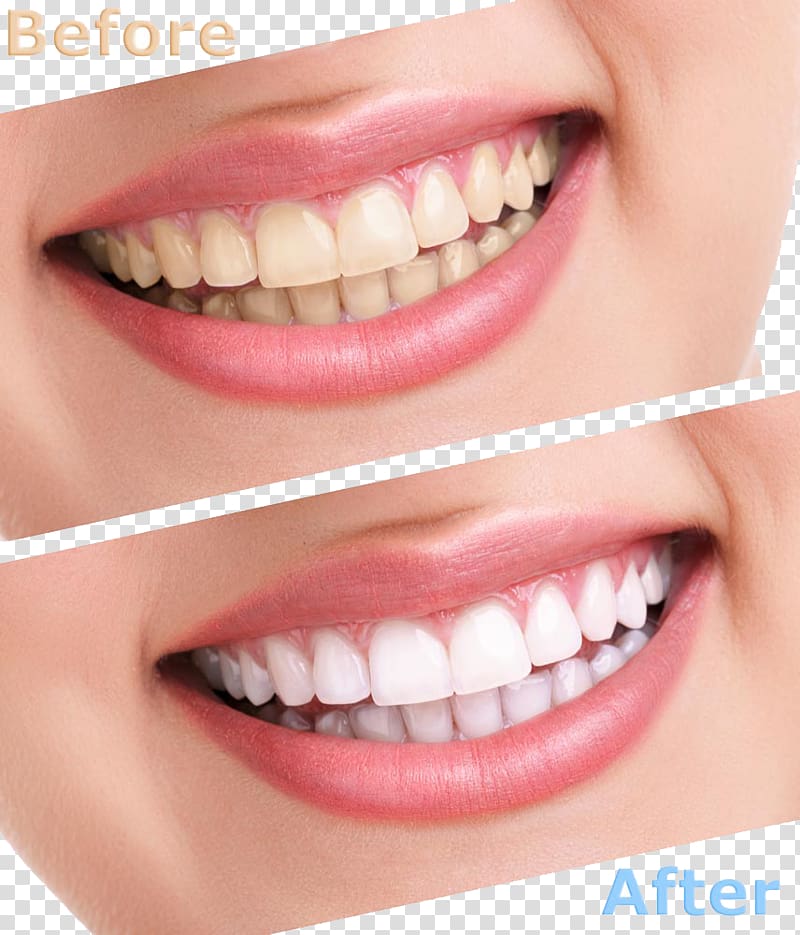 person showing teeth collage with text overlay, Tooth whitening Human tooth Cosmetic dentistry, Comparison of cleaning teeth transparent background PNG clipart