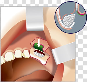 Sinus lift Bone grafting Implant Surgery, Sinus Lift transparent background PNG clipart thumbnail