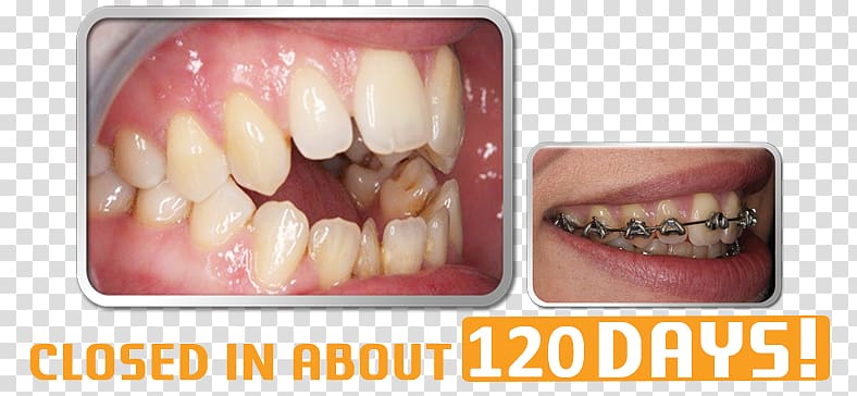 Tooth Orthodontics Dental braces Dentistry, Dental Braces transparent background PNG clipart