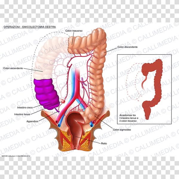 Colectomy Surgery Large intestine Colorectal cancer Human digestive system, 360 Degrees transparent background PNG clipart