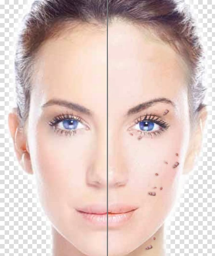 Laser Collagen induction therapy Skin Exfoliation Chemical peel, Laser skin transparent background PNG clipart