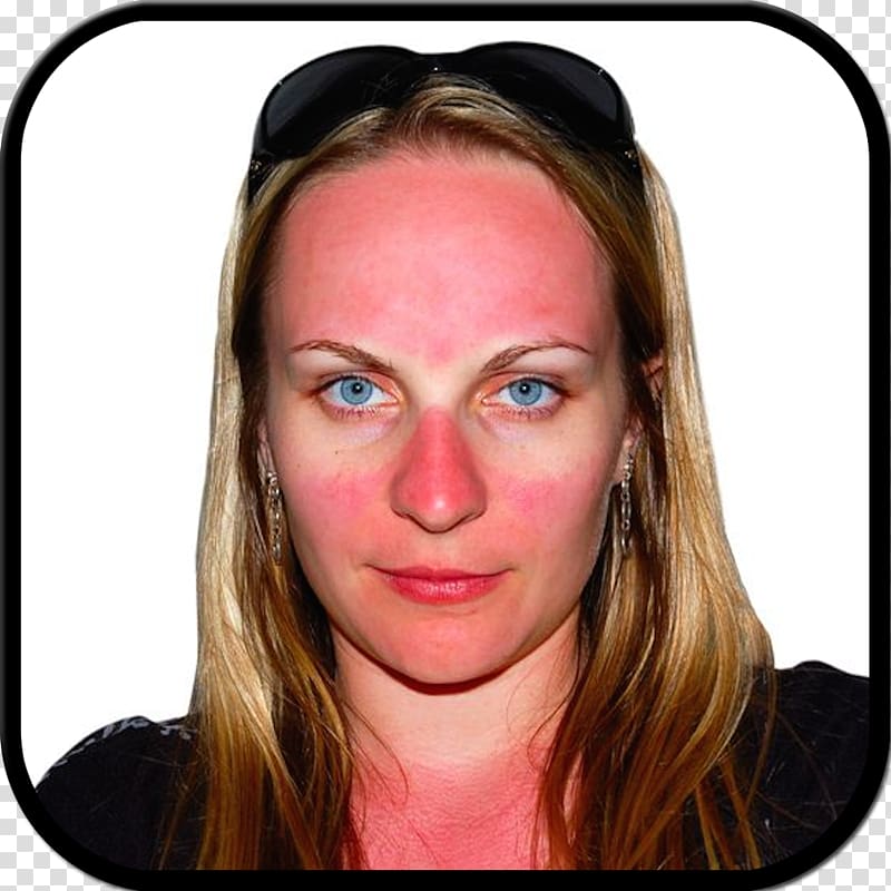 Sunburn Skin Face, burn transparent background PNG clipart