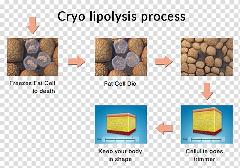 Cryolipolysis Liposuction Adipose tissue Cellulite, others transparent background PNG clipart