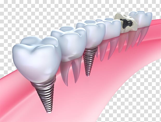 Dental implant Dentistry Bridge, bridge transparent background PNG clipart