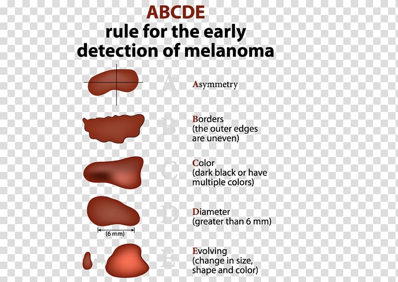 Melanoma Skin cancer Basal-cell carcinoma, others transparent background PNG clipart