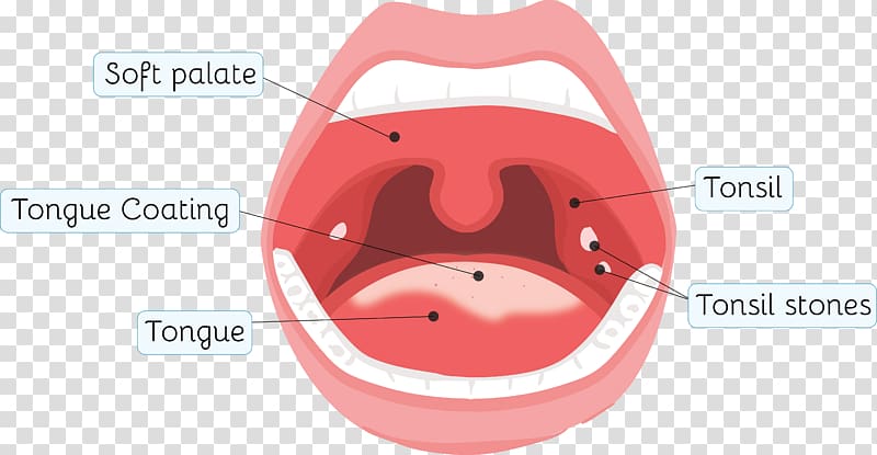 Tonsillolith Tonsillitis Throat Health, sore throat transparent background PNG clipart