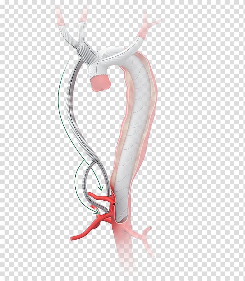 Surgery Graft Aorta Aortic dissection Anastomosis, others transparent background PNG clipart