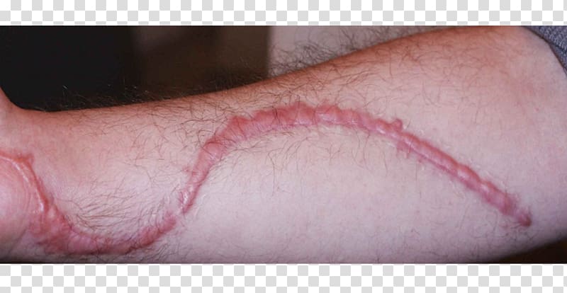 Hypertrophic scar Skin Hypertrophy Thumb, scar transparent background PNG clipart