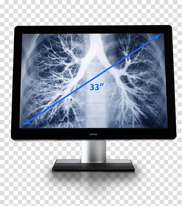 Chest radiograph Lung transplantation Health X-ray, ipad bezel highres transparent background PNG clipart