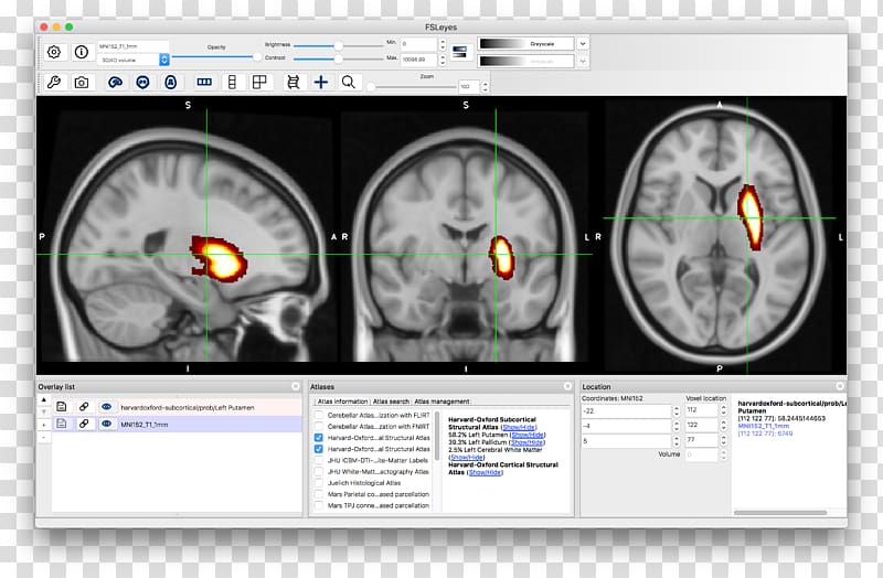 Brain Computed tomography Neuroimaging, Brain transparent background PNG clipart