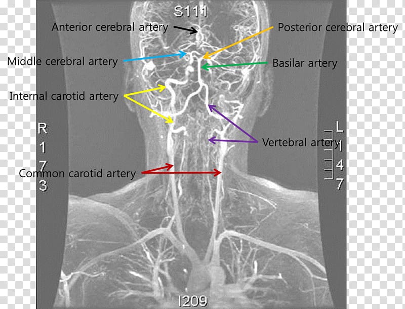 Medical imaging Vertebral artery dissection Blood vessel, Anterior Cerebral Artery transparent background PNG clipart