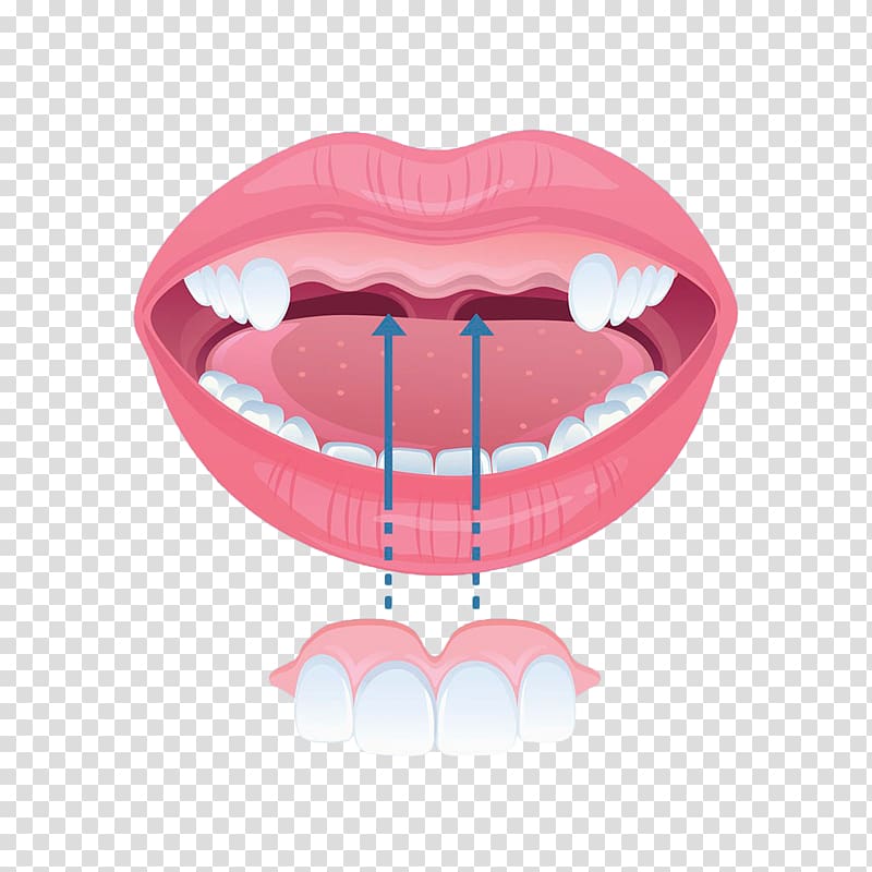 Tooth Incisor Dental braces Dentures, Hand-painted front teeth braces transparent background PNG clipart
