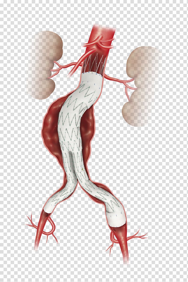 Abdominal aortic aneurysm Endovascular aneurysm repair Aorta, others transparent background PNG clipart