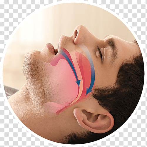 Obstructive sleep apnea Snoring Mandibular advancement splint Dentist, Sleep disorder transparent background PNG clipart