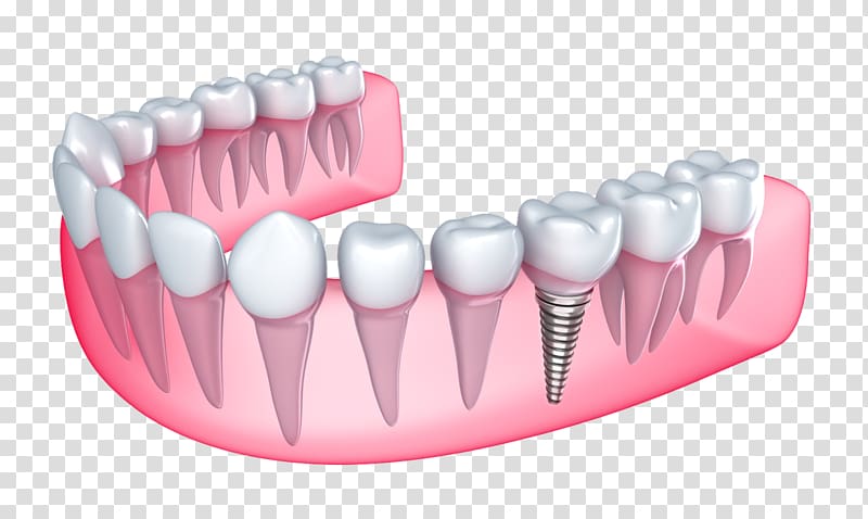 Dental implant Dentistry Tooth loss, bridge transparent background PNG clipart