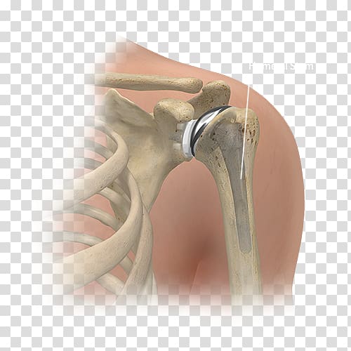 Shoulder replacement Joint replacement Surgery Knee replacement, American Joint Replacement Registry transparent background PNG clipart