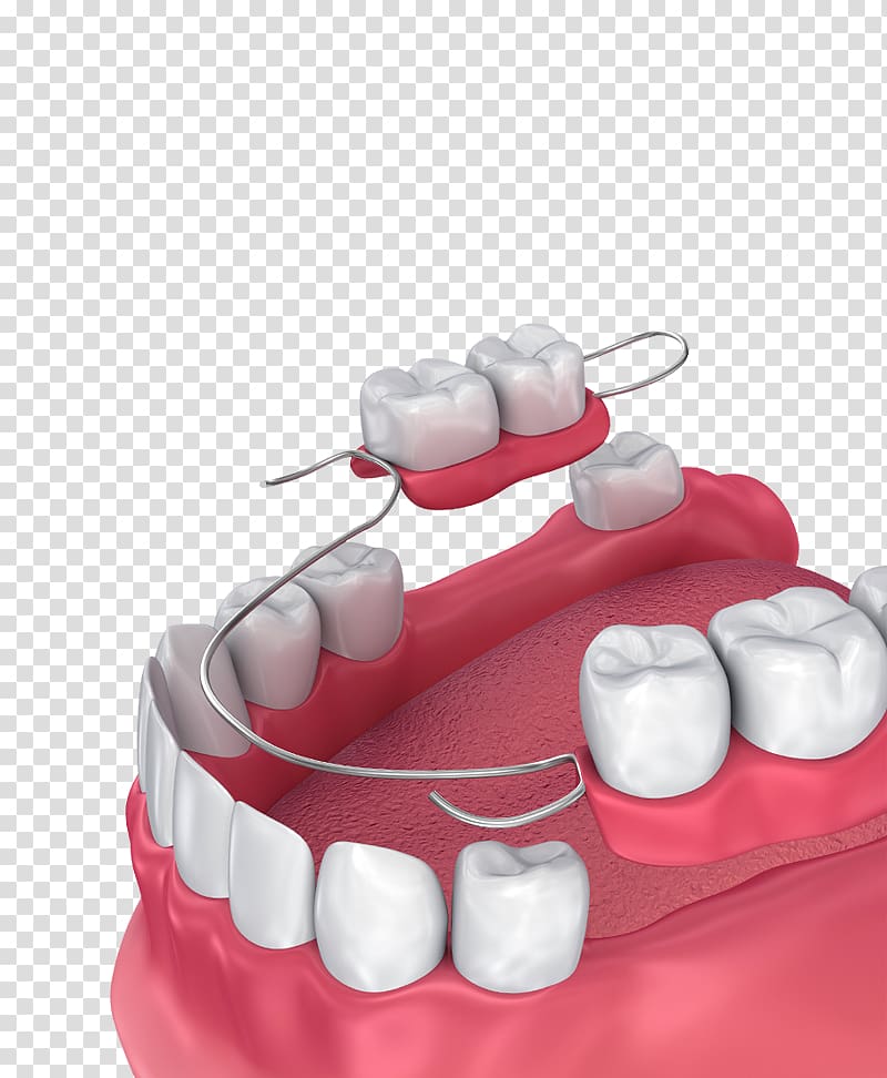 Removable partial denture Dentures Dentistry Bridge Tooth, bridge transparent background PNG clipart