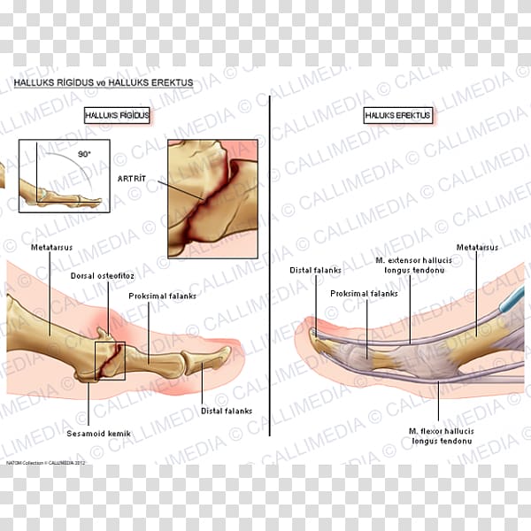 Foot Hallux rigidus Phalanx bone Sesamoid bone, hand transparent background PNG clipart