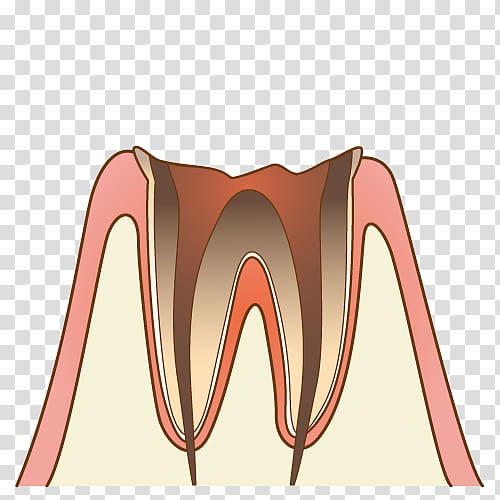 歯科 Dentist Periodontal disease Tooth decay, tooth cavity transparent background PNG clipart