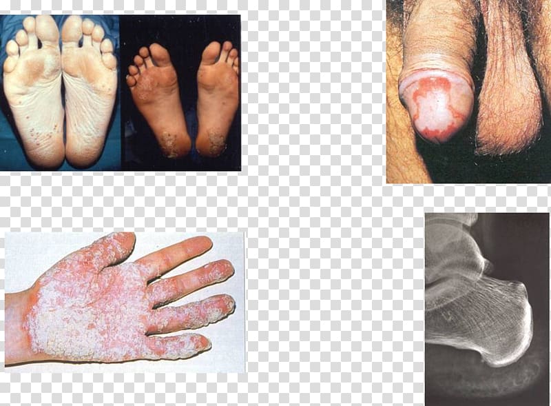 Reactive arthritis Disease Balanitis circinata Spondyloarthropathy, arthritis transparent background PNG clipart