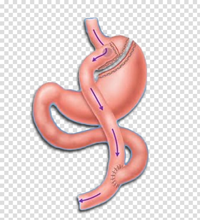 Roux-en-Y anastomosis Gastric bypass surgery Bariatric surgery Sleeve gastrectomy, Gastric Bypass Surgery transparent background PNG clipart
