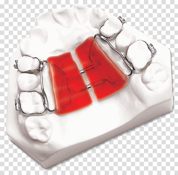 DynaFlex Palatal expansion Orthodontics Orthodontic technology Maxilla, Palatal Expansion transparent background PNG clipart