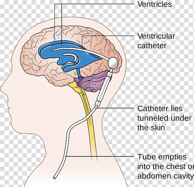 Cerebral shunt Neurosurgery Hydrocephalus Cerebrospinal fluid, Brain transparent background PNG clipart