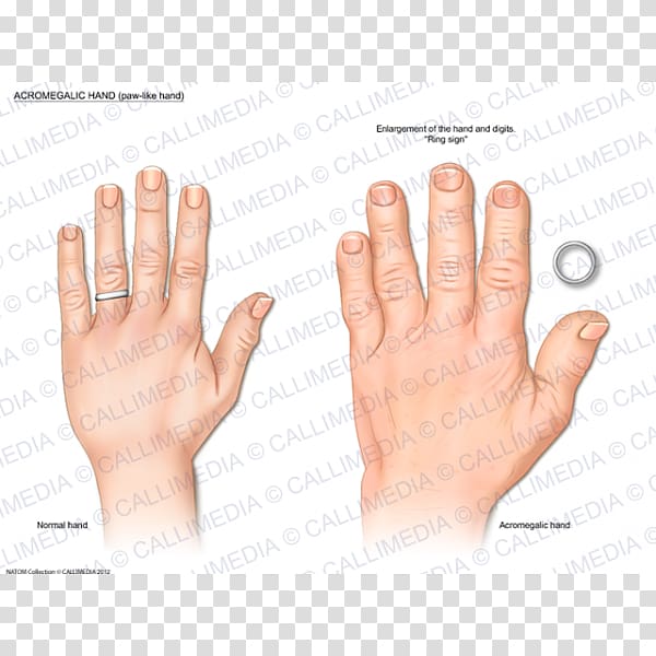 Thumb Acromegaly Hand Endocrinology Growth hormone, hand transparent background PNG clipart