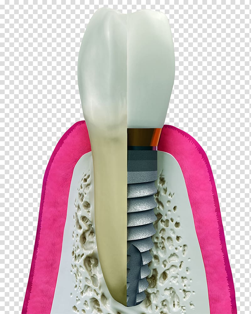 Dental implant Dentistry Surgery, Implants transparent background PNG clipart