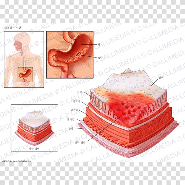 Peptic ulcer disease Skin ulcer Erosion Mucous membrane Mouth ulcer, ulcer transparent background PNG clipart