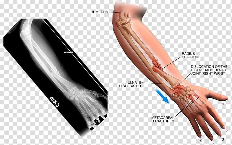Thumb Arm Sprain X-ray, Arm sprained transparent background PNG clipart