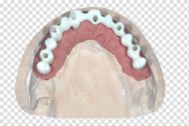 Bridge Jaw Dental implant Diagnostic wax-up Zirconium dioxide, bridge transparent background PNG clipart