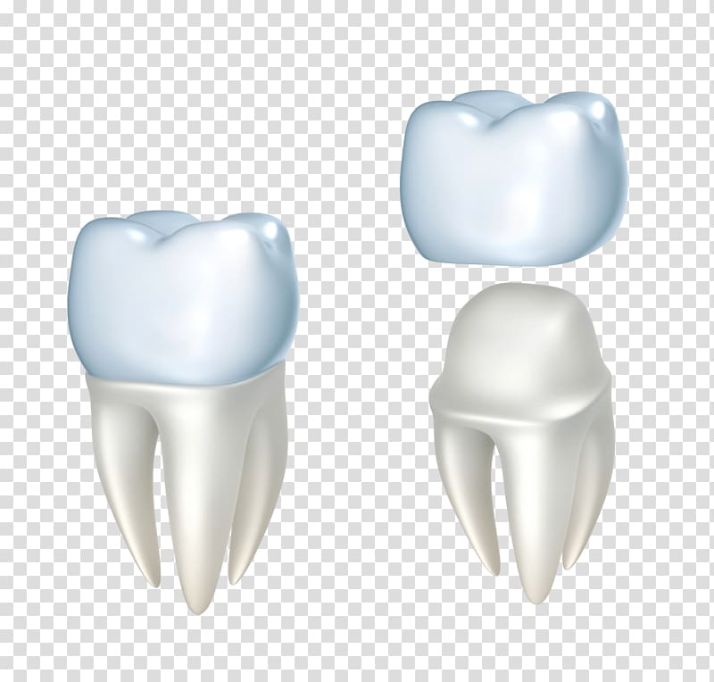 Crown Dentistry Dental restoration Bridge, dental floss transparent background PNG clipart