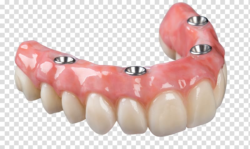 dentures illustration, Dental implant Dentures All-on-4 Removable partial denture Bridge, dentistry transparent background PNG clipart