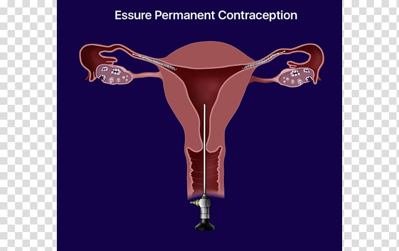 Essure Birth control Sterilization Intrauterine device Copper IUDs, others transparent background PNG clipart