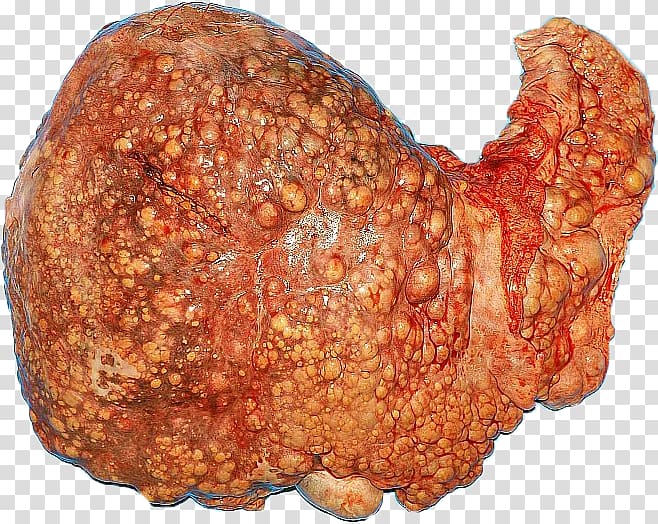 Cirrhosis Alcoholic drink Liver Hepatitis C, liver transparent background PNG clipart