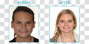 Eyebrow Hair coloring Cheek Chin Forehead, Orthodontic correction transparent background PNG clipart thumbnail