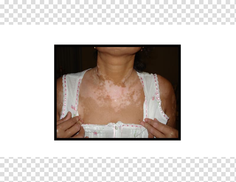Vitiligo Disease Skin Therapy Health, health transparent background PNG clipart