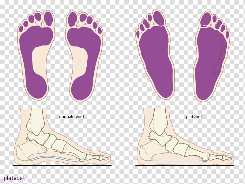 Foot Flat feet Spreidvoet Patient Knee, others transparent background PNG clipart