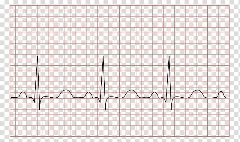 Electrocardiography Sinus tachycardia Heart rate, svt heart rate ecg transparent background PNG clipart