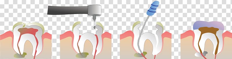 Endodontic therapy Root canal Endodontics Pulp Dentist, health transparent background PNG clipart
