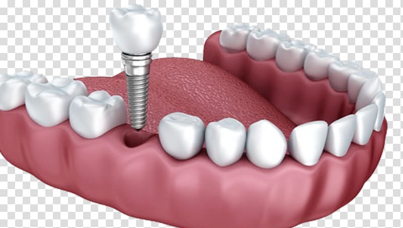 Dental implant Dentistry Dentures, dental anatomy of teeth transparent background PNG clipart